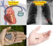 World’s smallest and lightest leadless pacemaker MICRA implanted at Fortis Malar Hospital